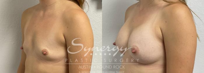 Before & After Breast Augmentation Case 858 Right Oblique View in Austin, TX