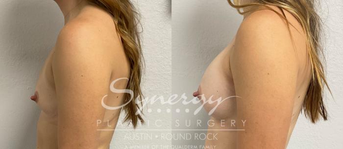 Before & After Breast Augmentation Case 858 Right Side View in Austin, TX