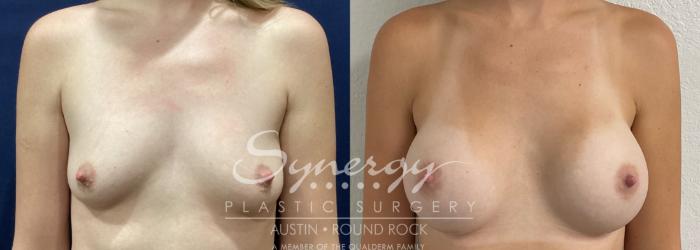 Before & After Breast Augmentation Case 863 Front View in Austin, TX