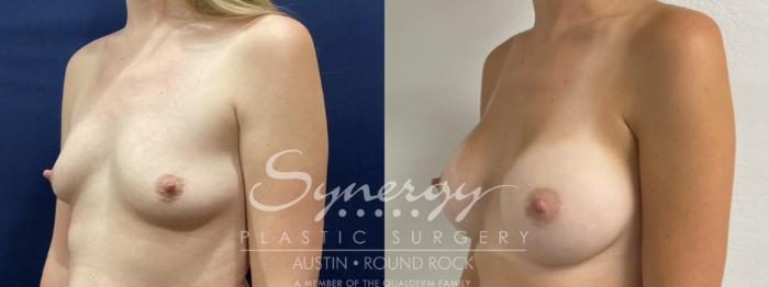 Before & After Breast Augmentation Case 863 Left Oblique View in Austin, TX