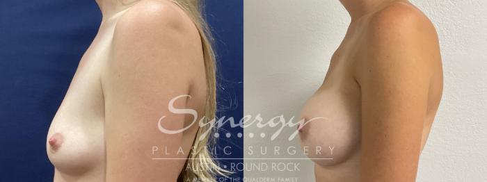 Before & After Breast Augmentation Case 863 Left Side View in Austin, TX