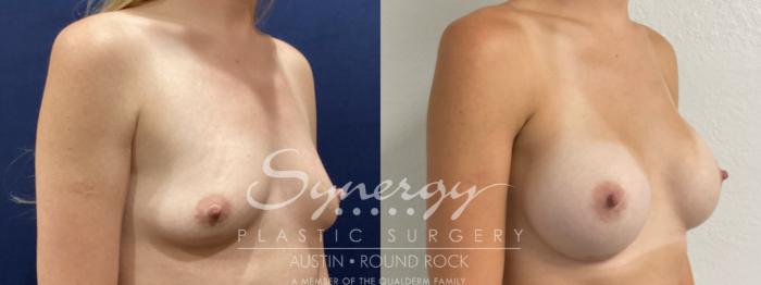 Before & After Breast Augmentation Case 863 Right Oblique View in Austin, TX