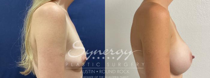 Before & After Breast Augmentation Case 863 Right Side View in Austin, TX