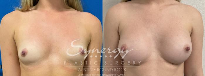 Before & After Breast Augmentation Case 864 Front View in Austin, TX