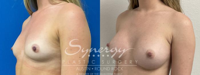 Before & After Breast Augmentation Case 864 Left Oblique View in Austin, TX