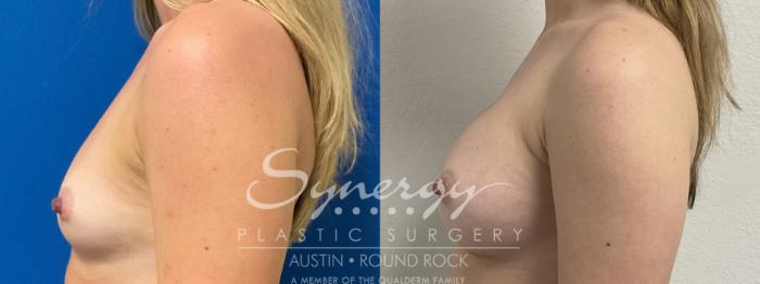 Before & After Breast Augmentation Case 864 Left Side View in Austin, TX