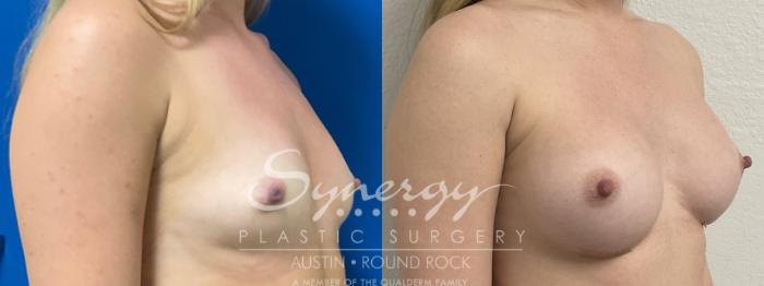 Before & After Breast Augmentation Case 864 Right Oblique View in Austin, TX