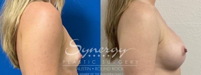 Before & After Breast Augmentation Case 864 Right Side View in Austin, TX