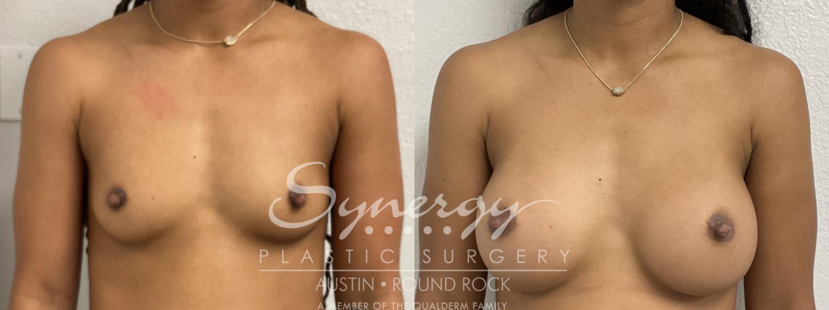 Before & After Breast Augmentation Case 865 Front View in Austin, TX