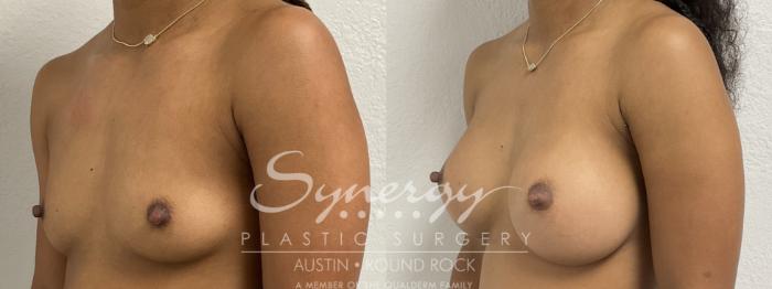 Before & After Breast Augmentation Case 865 Left Oblique View in Austin, TX