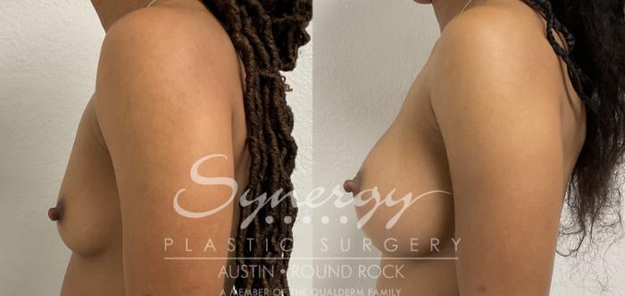 Before & After Breast Augmentation Case 865 Left Side View in Austin, TX
