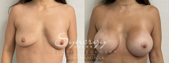 Before & After Breast Augmentation Case 866 Front View in Austin, TX