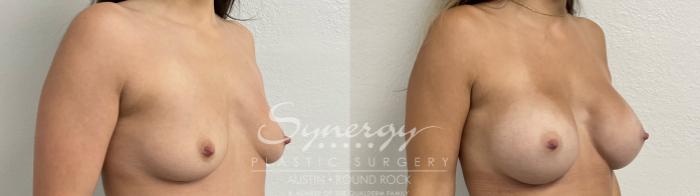 Before & After Breast Augmentation Case 866 Left Oblique View in Austin, TX