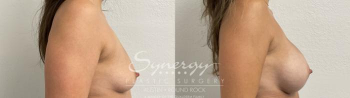 Before & After Breast Augmentation Case 866 Left Side View in Austin, TX