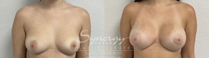 Before & After Breast Augmentation Case 867 Front View in Austin, TX