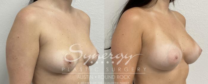 Before & After Breast Augmentation Case 867 Left Oblique View in Austin, TX