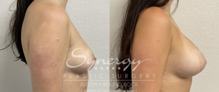 Before & After Breast Augmentation Case 867 Left Side View in Austin, TX
