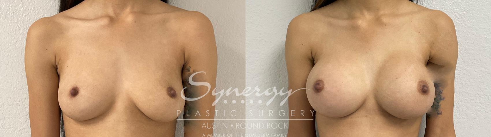 Before & After Breast Augmentation Case 870 Front View in Austin, TX