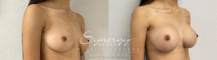 Before & After Breast Augmentation Case 870 Right Oblique View in Austin, TX