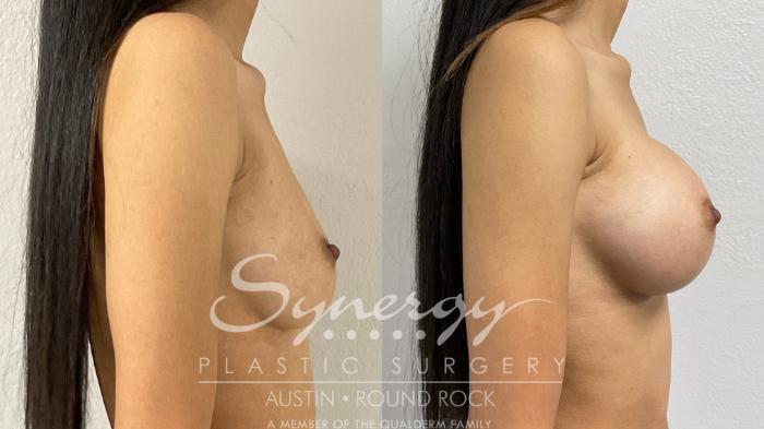Before & After Breast Augmentation Case 870 Right Side View in Austin, TX