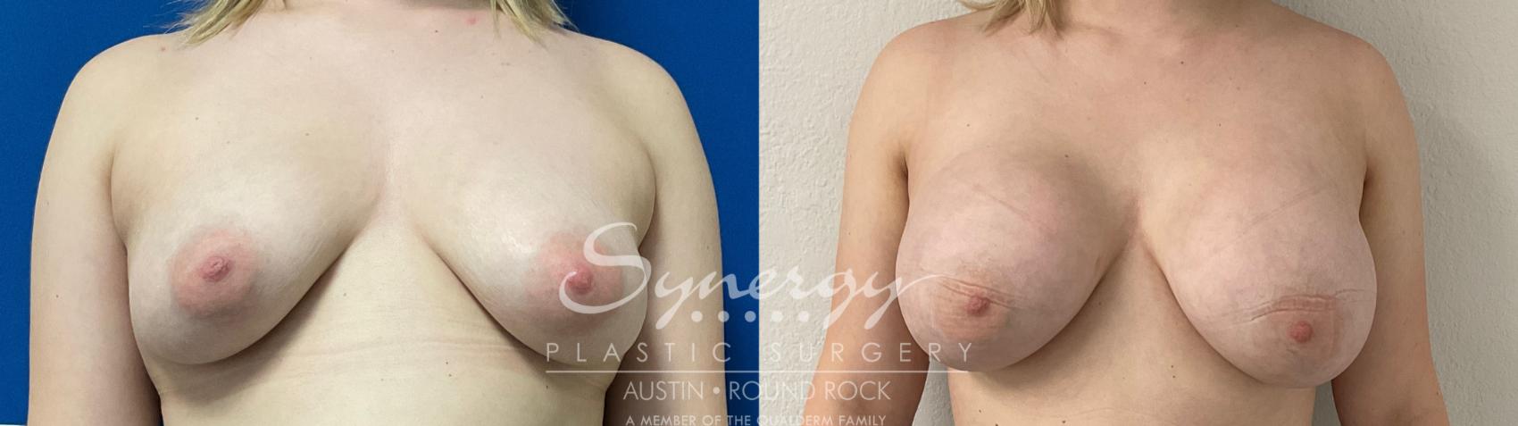 Before & After Breast Augmentation Case 872 Front View in Austin, TX