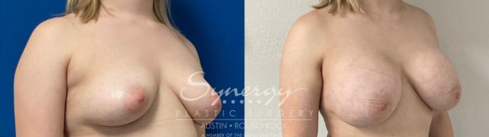 Before & After Breast Augmentation Case 872 Left Oblique View in Austin, TX