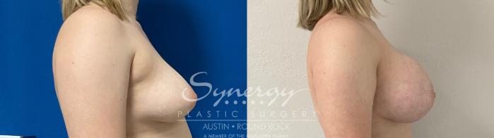 Before & After Breast Augmentation Case 872 Left Side View in Austin, TX