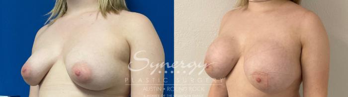 Before & After Breast Augmentation Case 872 Right Oblique View in Austin, TX