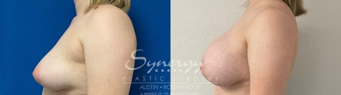 Before & After Breast Augmentation Case 872 Right Side View in Austin, TX
