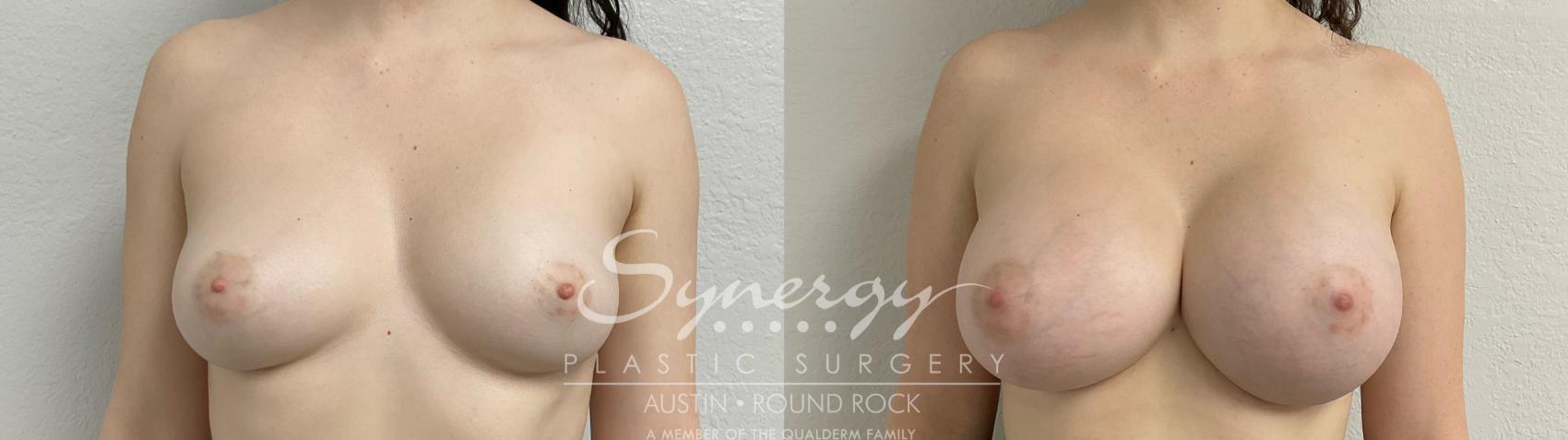 Before & After Breast Augmentation Case 873 Front View in Austin, TX