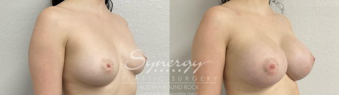 Before & After Breast Augmentation Case 873 Left Oblique View in Austin, TX