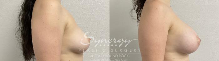 Before & After Breast Augmentation Case 873 Left Side View in Austin, TX