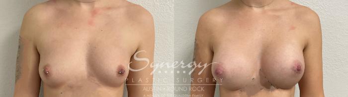 Before & After Breast Augmentation Case 875 Front View in Austin, TX