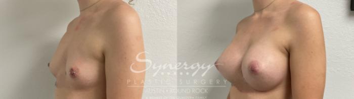 Before & After Breast Augmentation Case 875 Right Oblique View in Austin, TX