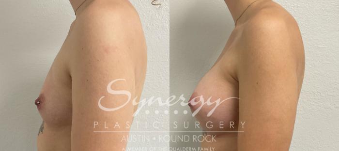Before & After Breast Augmentation Case 875 Right Side View in Austin, TX