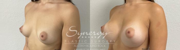 Before & After Breast Augmentation Case 876 Right Oblique View in Austin, TX