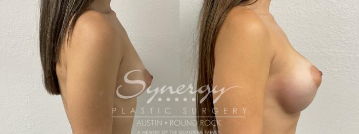 Before & After Breast Augmentation Case 876 Right Side View in Austin, TX