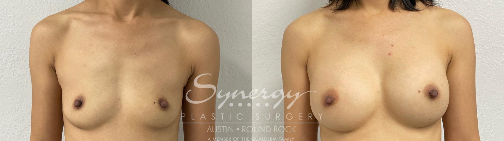 Before & After Breast Augmentation Case 878 Front View in Austin, TX