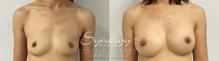 Before & After Breast Augmentation Case 878 Front View in Austin, TX