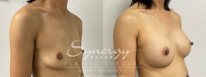 Before & After Breast Augmentation Case 878 Left Oblique View in Austin, TX