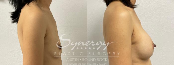 Before & After Breast Augmentation Case 878 Left Side View in Austin, TX