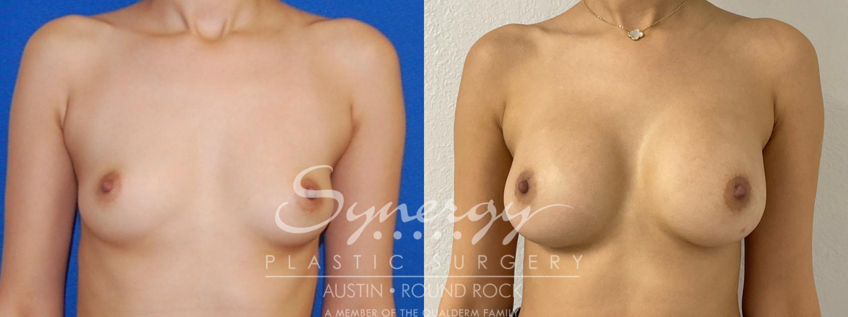 Before & After Breast Augmentation Case 880 Front View in Austin, TX