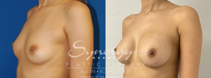 Before & After Breast Augmentation Case 880 Right Oblique View in Austin, TX