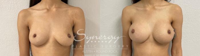 Before & After Breast Augmentation Case 883 Front View in Austin, TX