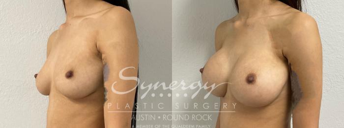 Before & After Breast Augmentation Case 883 Right Oblique View in Austin, TX
