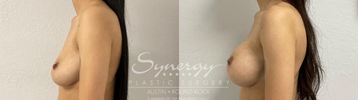 Before & After Breast Augmentation Case 883 Right Side View in Austin, TX
