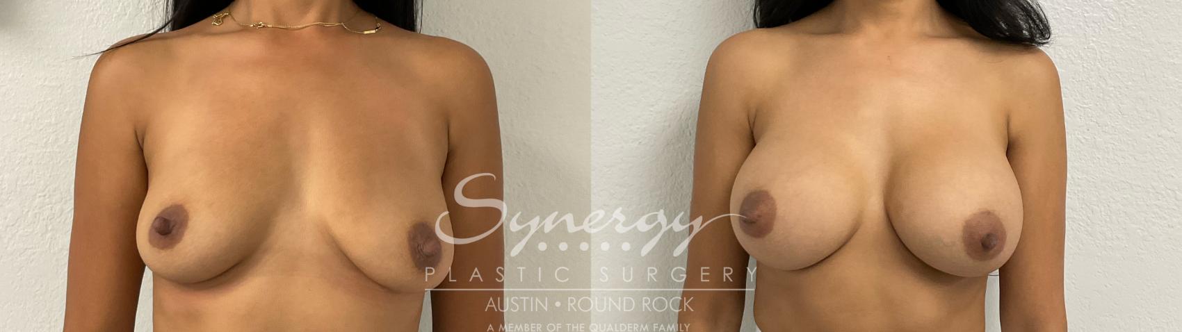 Before & After Breast Augmentation Case 884 Front View in Austin, TX