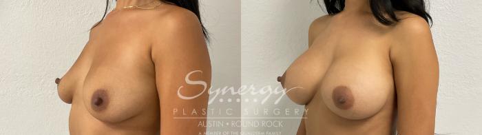 Before & After Breast Augmentation Case 884 Right Oblique View in Austin, TX