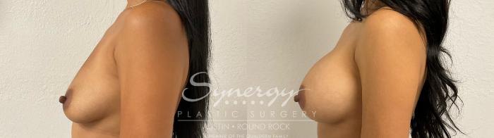 Before & After Breast Augmentation Case 884 Right Side View in Austin, TX