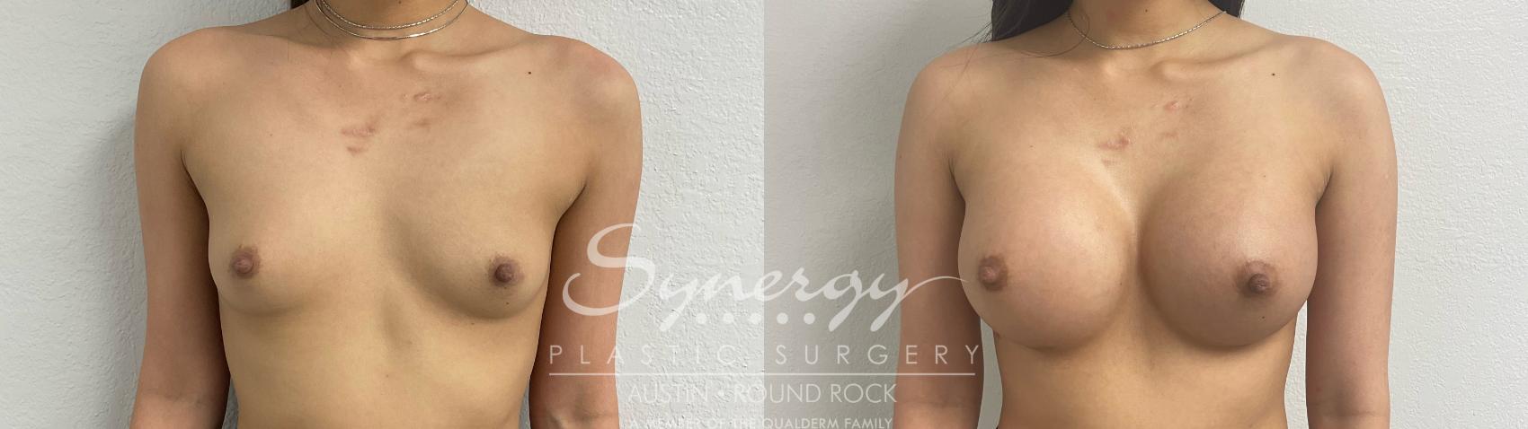 Before & After Breast Augmentation Case 887 Front View in Austin, TX